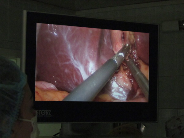 Хирург видит операцию на экране монитора
